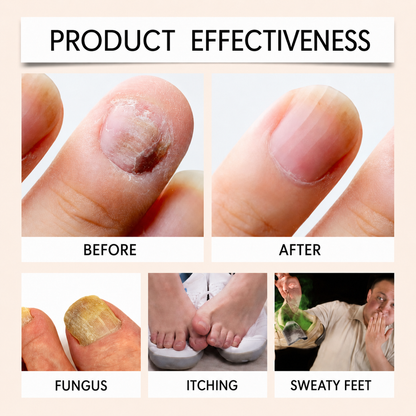 Bee Venom Nail Fungus Spray